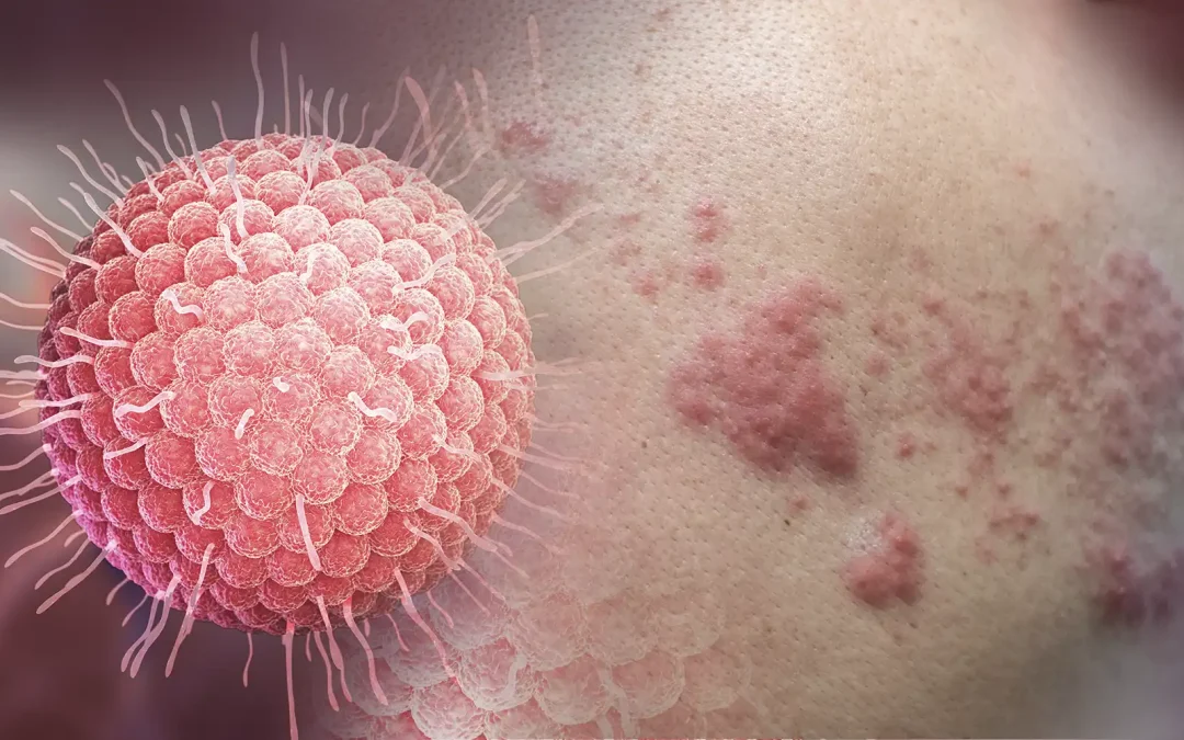 Herpes Zóster: terapia par biomagnético